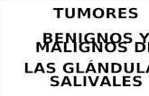 Tumores Benignos y Malignos de Las Glándulas Salivales