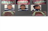 Exposicion de caso clinico de cirugia de 3 molar