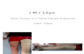 Non Union (L) Tibia Fibula Fracture