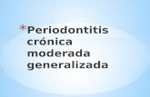 Periodontitis crónica moderada generalizada