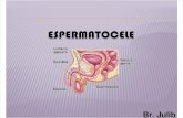 Mis Diapositivas de Espermatocele