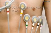 Electrocardiograma normal y Arritmias