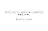Cerebro normal y patologías vasculares