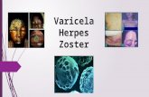 Presentacion de herpes zoster