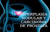 HIPERPLASIA NODULAR Y CARCINOMA DE PRÓSTATA