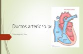 Ductos arterioso persistente