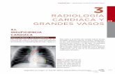 RADIOLOGÍA CARDIACA Y GRANDES VASOSmedia.axon.es/pdf/93221.pdf · ( 43 ) Capítulo 03 ... [Radiología cardíaca y grandes vasos] 03 Además de la cardiomegalia, en un paciente con