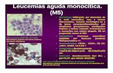 Leucemias aguda monocítica. (M5)ecaths1.s3.amazonaws.com/hematologiaclinicafacena... · Leucemias aguda megacarioblástica. (M7) Blastos con cromatina densa y citoplasma reticulado.