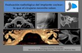 Evaluación radiológica del implante coclear: lo que el ...seram2010.seram.es/modules/posters/files/implante_coclearpdf.pdf · El nervio coclear es generalmente mayor que el facial,