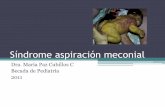 Síndrome aspiración meconial - manuelosses.clmanuelosses.cl/BNN/SAM_MPC.pdf · Hipoxemia Hipercapnia HTP 2º Rupturas alveolares . Clínica RNT o post maduro Piel impregnada de