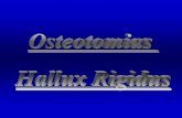 Presentación de PowerPoint - robertodelosmozos.com · — Retracción del tendón flexor largo — Gran esclerosis periarticular — Marcha en supinación — Hipertrofia osteofítica
