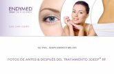 ENDYMED - Laser&Esthetics, tu centro de estética …laser-esthetics.es/wp-content/uploads/2017/03/ENDYMED-antesdespu… · corporal, tratamiento de las cicatrices de acné, ... 7
