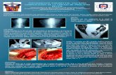 PSEUDOQUISTE PARARECTAL. UNA RARA … poster 8 de 8.pdf · Existen diversas técnicas tanto perineales como abdominales para corregir el prolapso rectal, ... aérea cónica cuyo vértice
