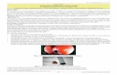 CASO CLÍNICO Perforación esofágica por cuerpo …scielo.iics.una.py/pdf/hn/v7n1/v7n1a09.pdf · instrumental, spontaneous, surgical, traumatic and by foreign bodies. Esophageal