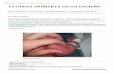 168 Lesiones nodulares en un neonato - Revista - … nodulares … · Lesiones nodulares en un neonato ... preeclampsia, diabetes gestacional, ... La hipercalcemia es la complicación
