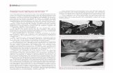 Aneurismas coronarios con compromiso de múltiples vasos: descripción de …scielo.org.ar/pdf/rac/v82n2/v82n2a18.pdf · 2016-04-04 · Aneurismas coronarios con compromiso de múltiples