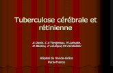 Tuberculose cérébrale et rétinienne - pe.sfrnet.orgpe.sfrnet.org/Data/ModuleConsultationPoster/pdf/2004/1/dae6ff65... · MILIAR; ARCHIVOS DE LA SOCIEDAD ESPAÑOLA DE OFTALMOLOGIA