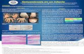 Onicomicosis en un infante - msldermatopato.com.mx · La onicomicosis es rara en la edad pediátrica por menor exposición a ambientes contaminados con hifas y esporas, crecimiento