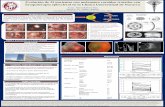 Evolución de 33 pacientes con melanoma coroideo tratados con ... · Zarranz-Ventura J, et al.Exudación lipídica masiva y desprendimiento de retina tras braquiterapia y termoterapia