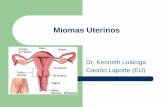 Miomas Uterinosloaiciga.com/documentos/miomas_uterinos.pdf · –Situados bajo el peritoneo visceral uterino ... – El mioma puede impedir la fecundación o la implantación.