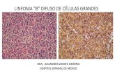 LINFOMA “B” DIFUSO DE CÉLULAS GRANDES - comanes.orgcomanes.org/reunionacademica_2017/linfoma_difuso_celulas_grandes.pdf · LINFOMA B DIFUSO DE CELULAS GRANDES • Grupo heterogéneo