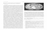 Hematoma retroperitoneal con neuropatía del femoral ...scielo.isciii.es/pdf/ami/v23n4/carta7.pdf · cios demostrados de la terapia anticoagulante en patologías como ... suele presentar