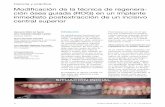 Modificación de la técnica de regenera- ción ósea guiada (ROG) … · 2018-10-22 · seguir un protocolo de exodoncia y colocación inmediata del implante, siguiendo un abordaje