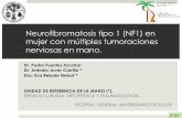 Neurofibromatosis tipo 1 (NF1) en mujer con múltiples ... 2015/PDF/P-44.pdf · Ecografía y RMN confirman la presencia de al menos tres lesiones nodulares. En ENG/EMG se demuestra