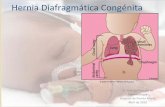 Hernia Diafragmática Congénitaneopuertomontt.com/ReunionesClinicas/Hernia diafrag.pdf · mínima para evitar el VILI (baro‐volutrauma) • Evitar la Hipertensión Pulmonar es