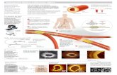 Tomografía Óptica Coherente (OCT) · Tomografía Óptica Coherente (OCT) La formación de la placa Se forma en las arterias a través de los años por un proceso llamado aterosclerosis,