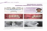 Edentulismo maxilar. Implantes inmediatos posexodoncia · desde hace 30. Acude para valorar una rehabilitación fija implantosoportada en el maxilar superior. En el maxilar superior
