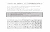 Ablación de una Taquicardia ventricular Idiopática Guiada ...cardiosangeronimo.com.ar/a/wp-content/uploads/2018/04/tvi-final-1.… · sitio de origen de la arritmia: 1) Através