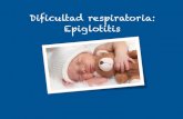 Dificultad respiratoria: Epiglotitis · 2016. 9. 15. · Epiglotitis Es una emergencia médica. Supone un compromiso vital. Consiste en una celulitis de las estructuras supraglóticas